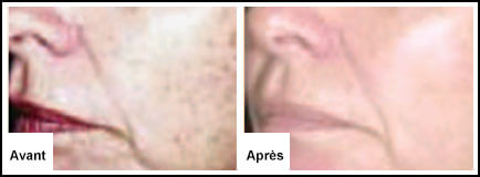 Traitement Laser facial : Peau endommagée par le soleil - Epilation laser 77 Chessy Derma Laser